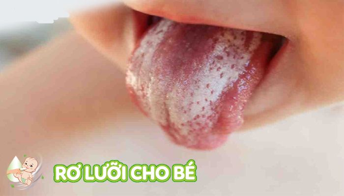 nấm lưỡi khiến bé bị sưng lưỡi