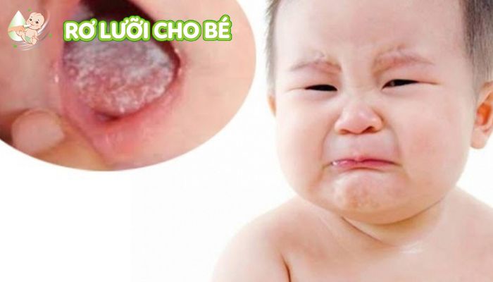 một số câu hỏi khi bị tưa lưỡi