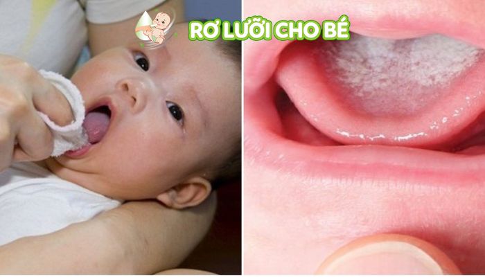 vệ sinh răng miệng hàng ngày giúp ngăn ngừa nấm lưỡi tái phát