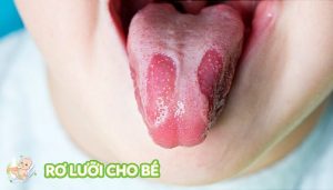 nấm bản đồ ở trẻ em