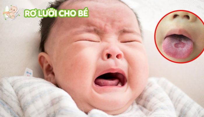 thuốc tưa lưỡi Nystatin hiệu quả trong điều trị nấm miệng