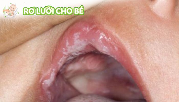 trẻ bị nấm lưỡi có đau không