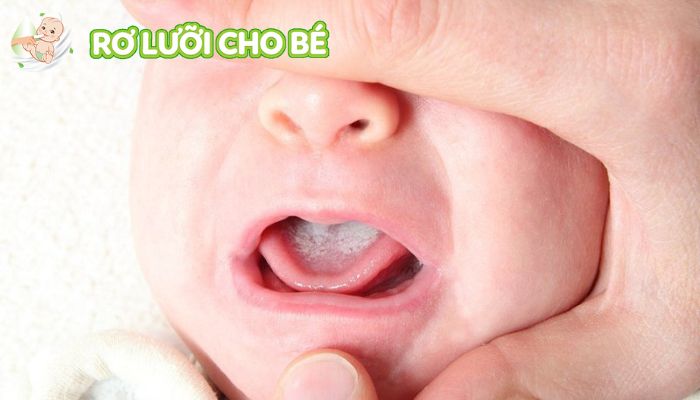 Trẻ ăn kém, bỏ ăn do khó chịu và đau nhiều khi bị nấm lưỡi nặng